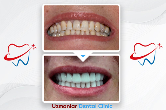 Slider image (6) Uzmanlar Dental Clinic